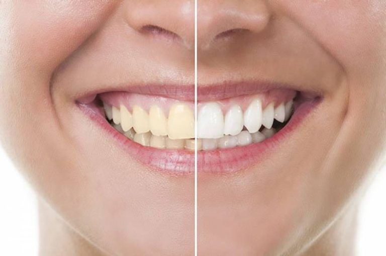 اصفرار الأسنان: الأسباب وطرق العلاج